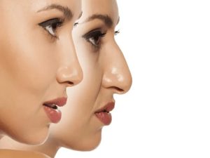 رینوپلاستی به چه افرادی توصیه می‌شود؟